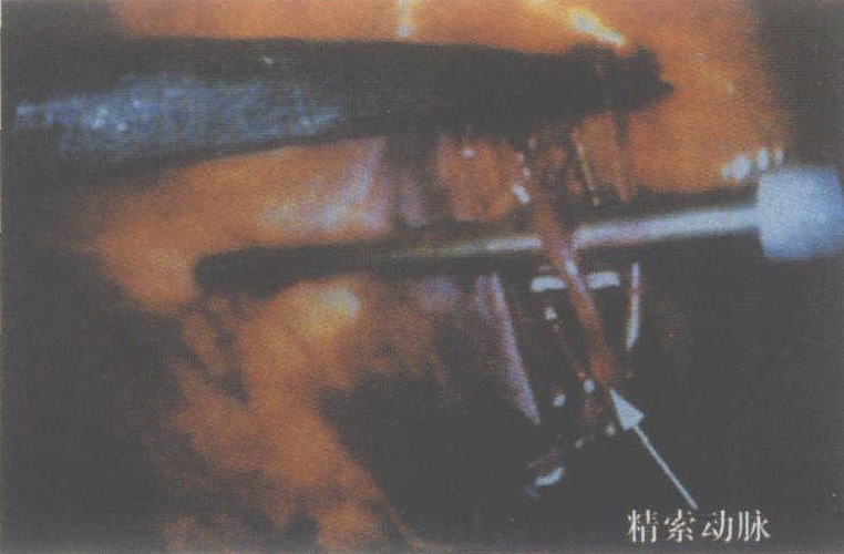 八、腹腔鏡精索靜脈曲張結(jié)扎術(shù)